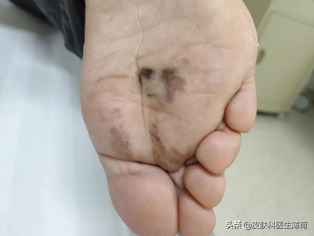 富贵痣点掉了,有福的痣点掉