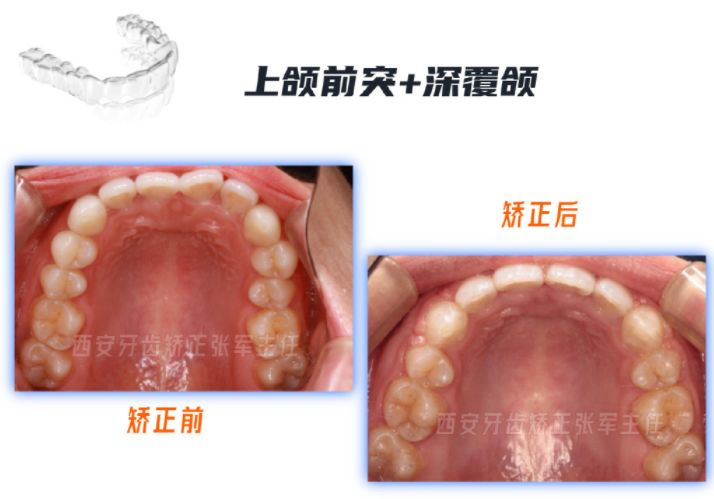 牙齿矫正雁塔区,矫正牙齿拔掉4颗智齿