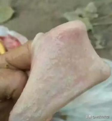 养殖场养鸡球虫如何根治,养鸡球虫反复发病怎么办