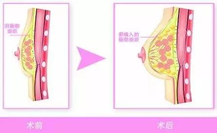 做了脂肪丰胸侧着睡觉会怎么样,做了脂肪丰胸会影响例假吗