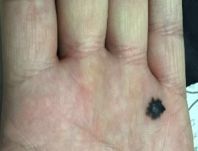 辟谣丨激光点痣不可取,小心“点”出恶性黑色素瘤！5步判断恶性痣