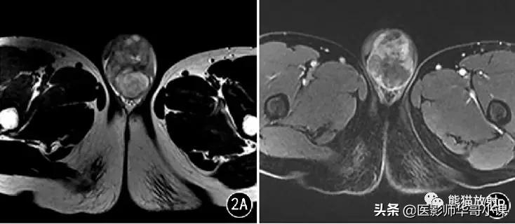 [精品课件]畸胎瘤及精原细胞瘤（*丸睾**肿瘤及肿瘤样变CT及MR表现）