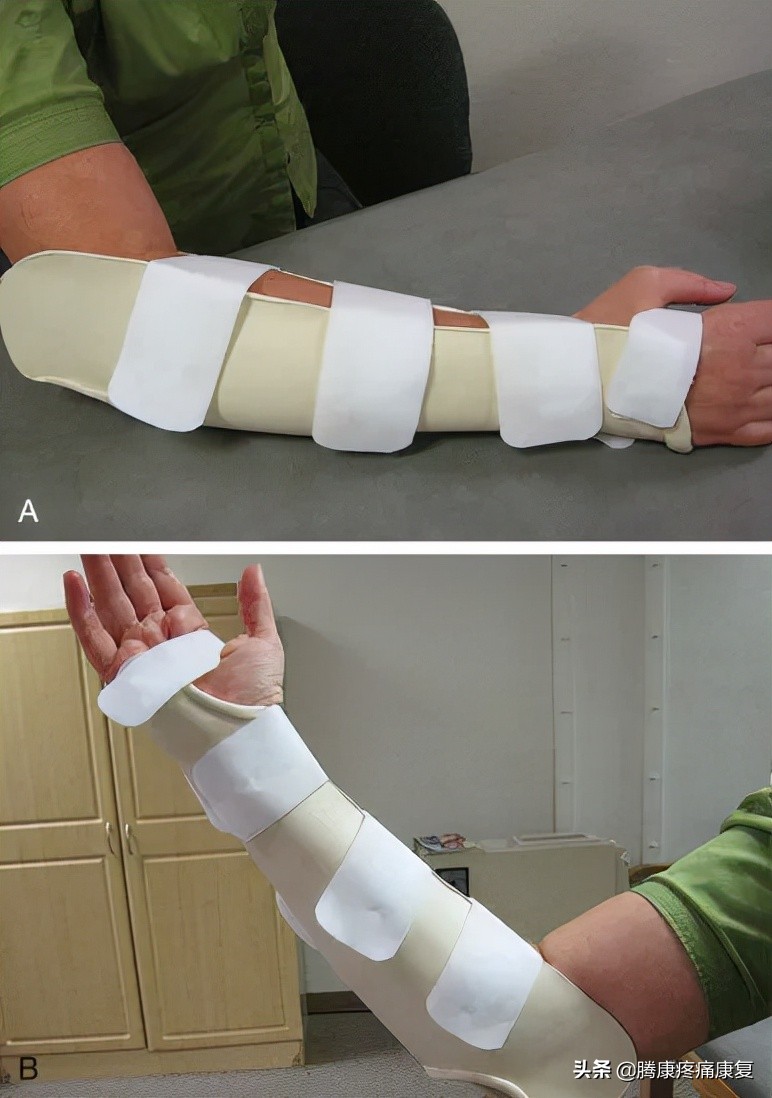 腕关节三角纤维软骨复合体损伤,三角纤维软骨损伤最佳治疗方法