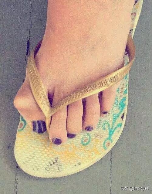 詹姆斯脚踝外翻对他的影响,詹姆斯的脚趾到底怎么回事