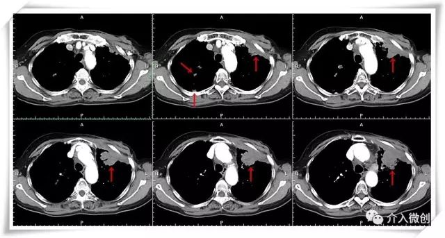 肺转移瘤消融能达到根治效果吗,肺转移瘤中医治疗