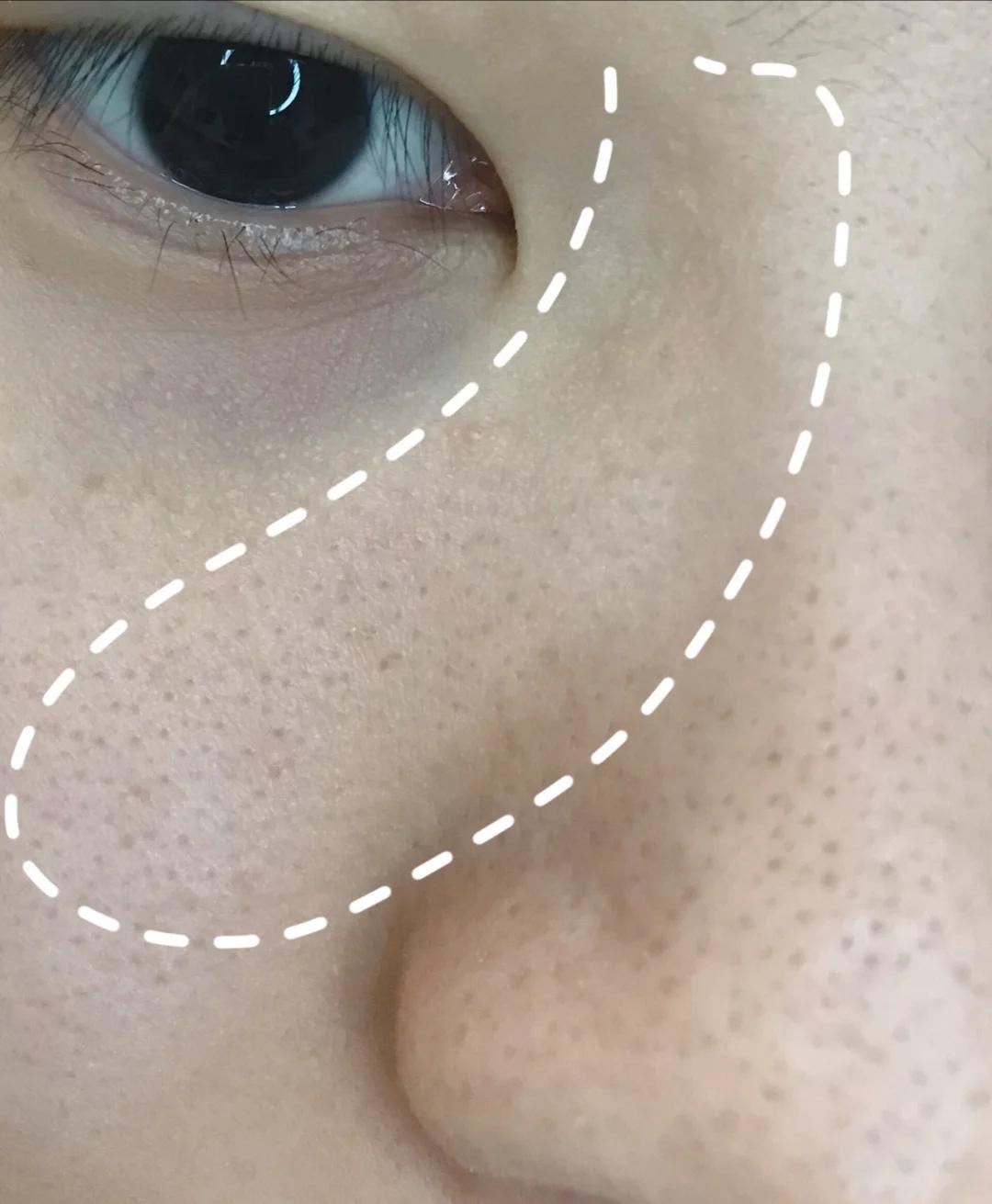 平价祛痘好物测评:理肤泉K乳见效快,红霉素软膏去闭口超赞