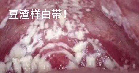 霉菌性阴道炎如何跟老公诉说,霉菌性阴道炎你们怎么治好的