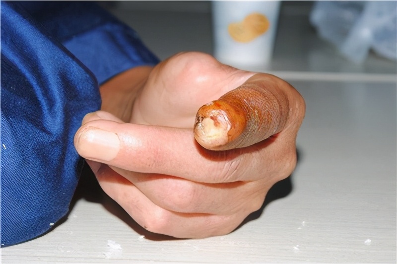 骨髓炎与慢性骨髓炎的区别,骨髓炎的解决方法