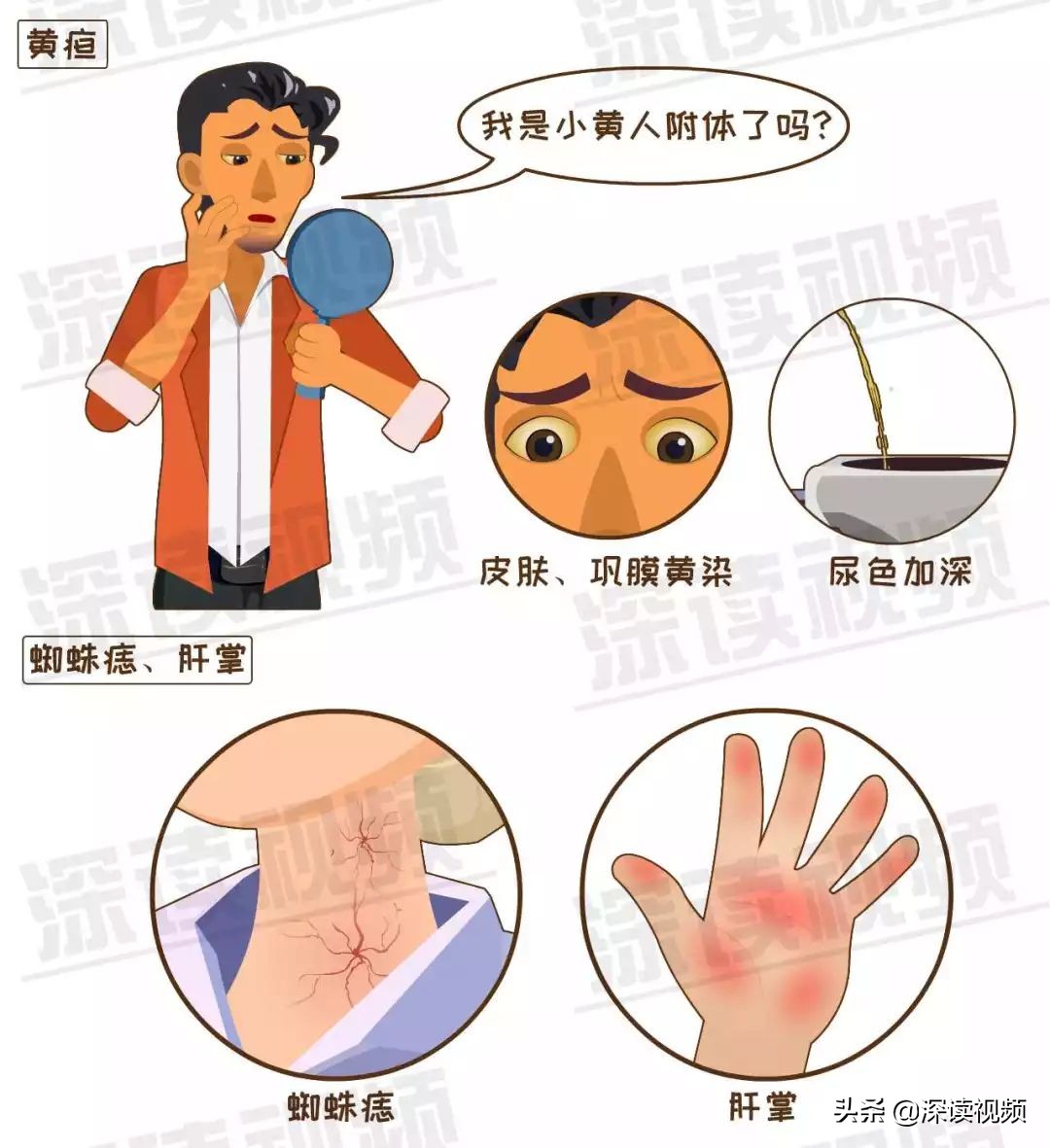 肝硬化70,肝硬化7.75严重吗