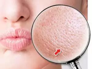 解决毛孔粗大一招帮你搞定,毛孔粗大怎么改善简单妙招