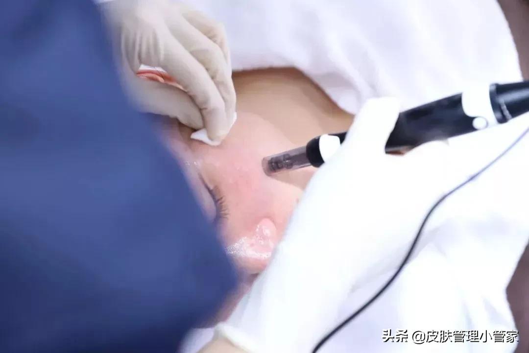 祛斑祛痘皮肤管理,皮肤管理祛痘有效吗