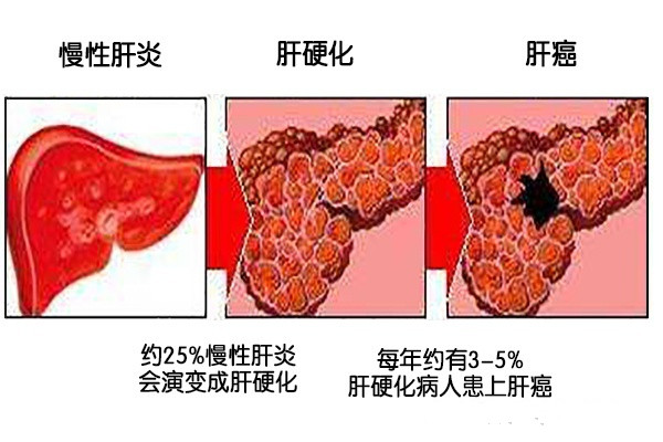 杨海波中医治疗肝癌早期方法,中医是如何应对肝癌