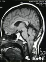 脑部脓肿怎么治疗,多发性脑脓肿能自愈吗