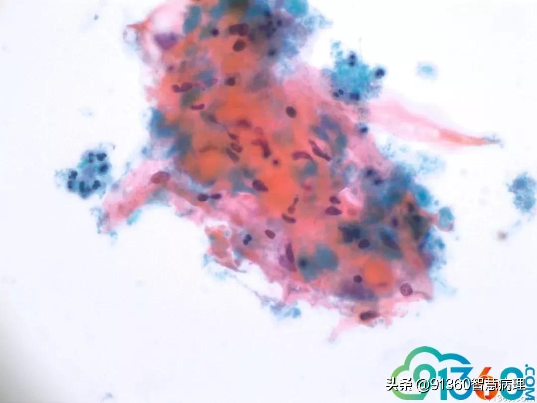 病理宫颈活检lsil是什么意思,宫颈病理检查与tct检查的区别