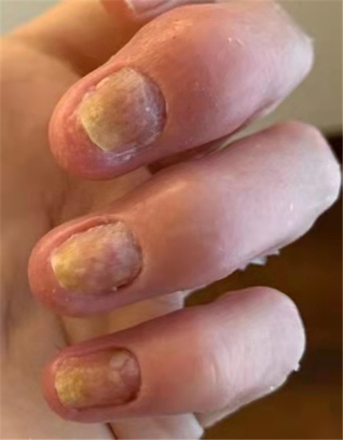 银屑病特效新药,银屑病关节炎专用药