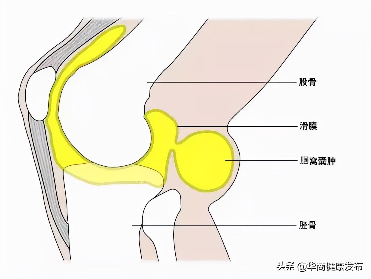脚膝盖腘窝囊肿手术要注意什么,腘窝囊肿关节镜切除
