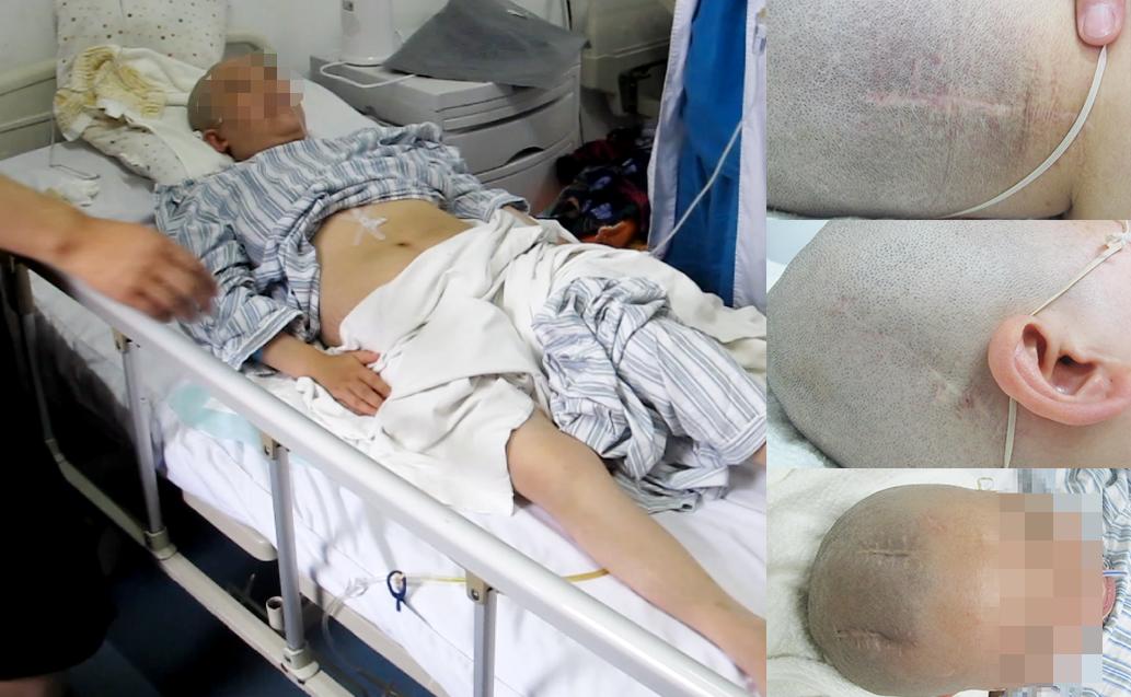 结核性脑积水,脑膜炎脑积水要治疗多久