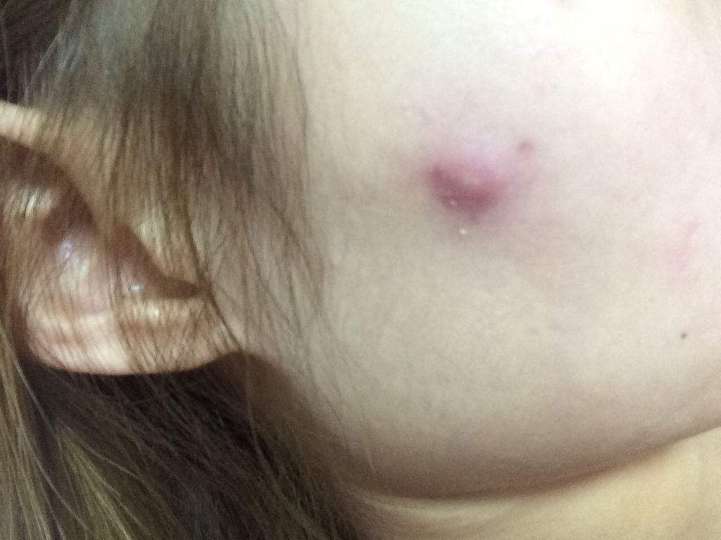 脸上痘痘一直反反复复怎么回事,脸上痘痘一直反复长痘印消不下去