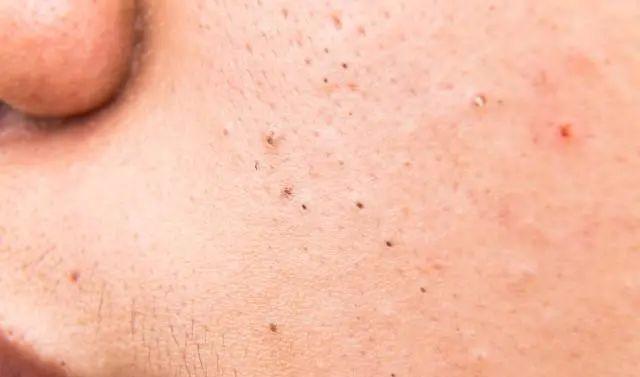 收缩毛孔黑头怎么湿敷,绿膜收缩毛孔去黑头