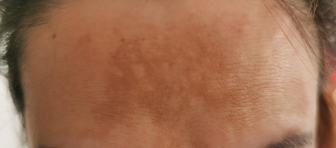 铅汞脸如何自救,那些被毁容的女孩