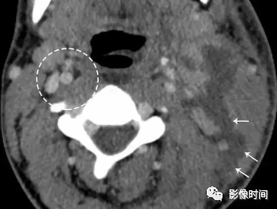 双侧颈动脉鞘间隙多发小淋巴结影,双侧颈动脉间隙多软组织密度结节