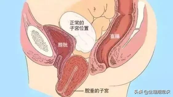 阴道里脱出块“肉”!