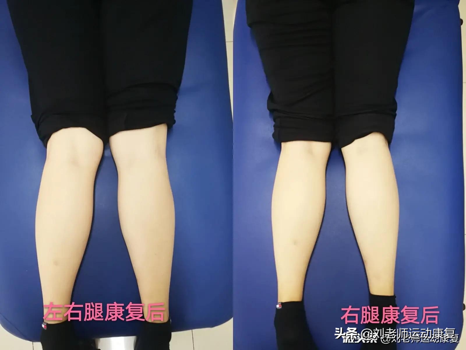 如何矫正xo腿型科学方法,康复科医生教你怎么矫正腿型