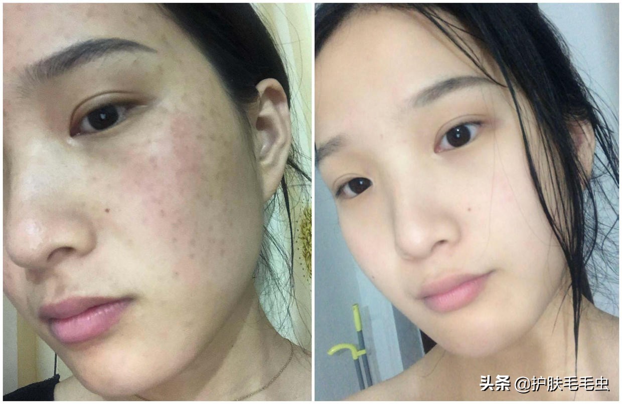脸颊两侧长斑的原因，脸上长斑怎么消除？三种方法，立竿见影