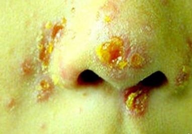 皮肤病种类脓包型,皮肤病痤疮简介