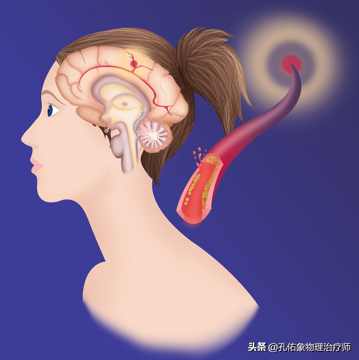 高血压脑出血突然发作该如何急救,高血压脑出血晕倒一小时急救