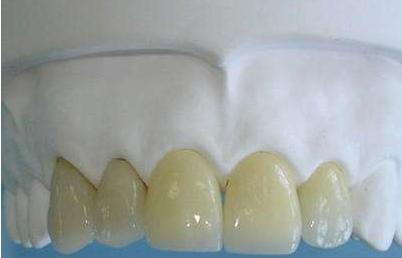 牙齿小知识烤瓷牙,牙医牙齿美白要做吗