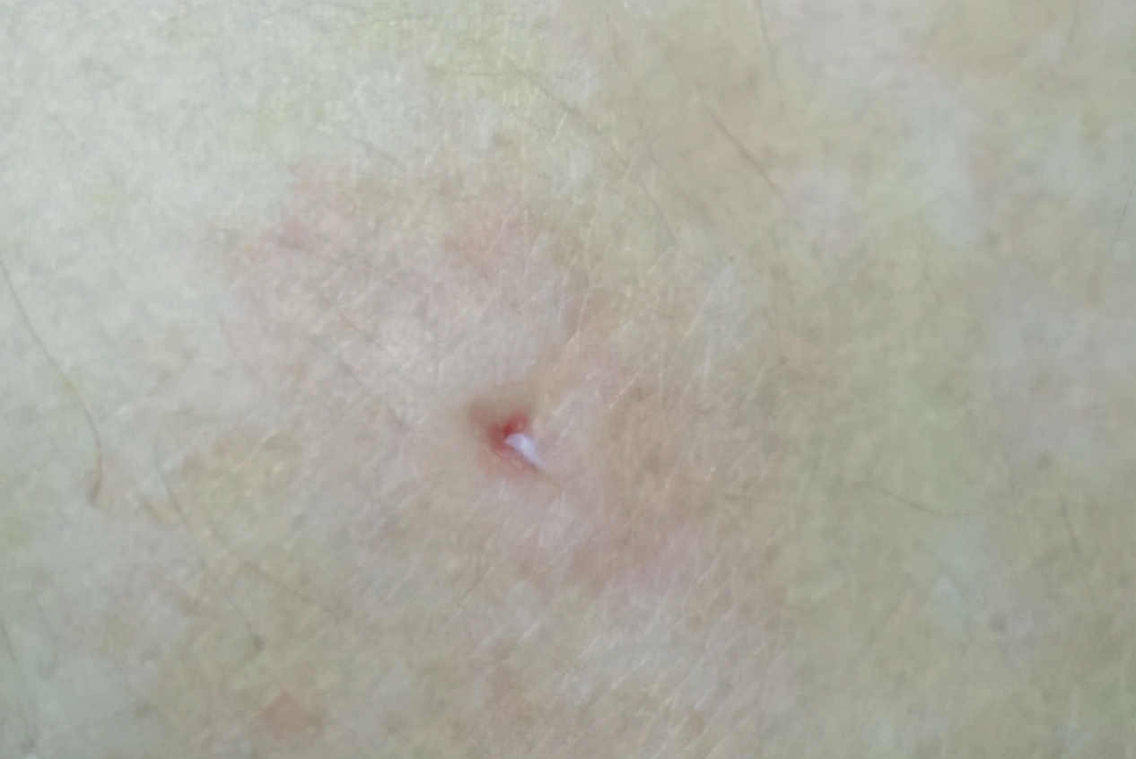 有痔疮的人后背有一道印,有痔疮突然出现小肉球