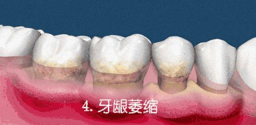 牙齿掉了要怎么做,怎么可以让牙齿掉