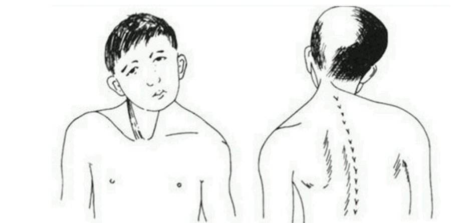 治疗痉挛性斜颈的秘诀：修正归位汤疏风通络、散寒祛湿，标本兼治