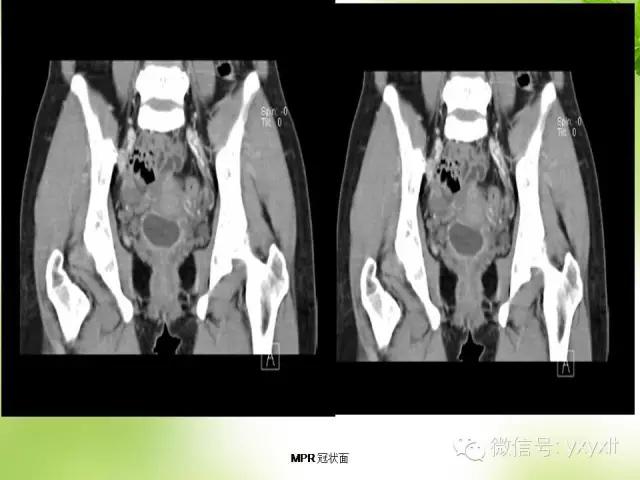 苗勒氏管囊肿在哪里,苗勒氏管囊肿是指什么