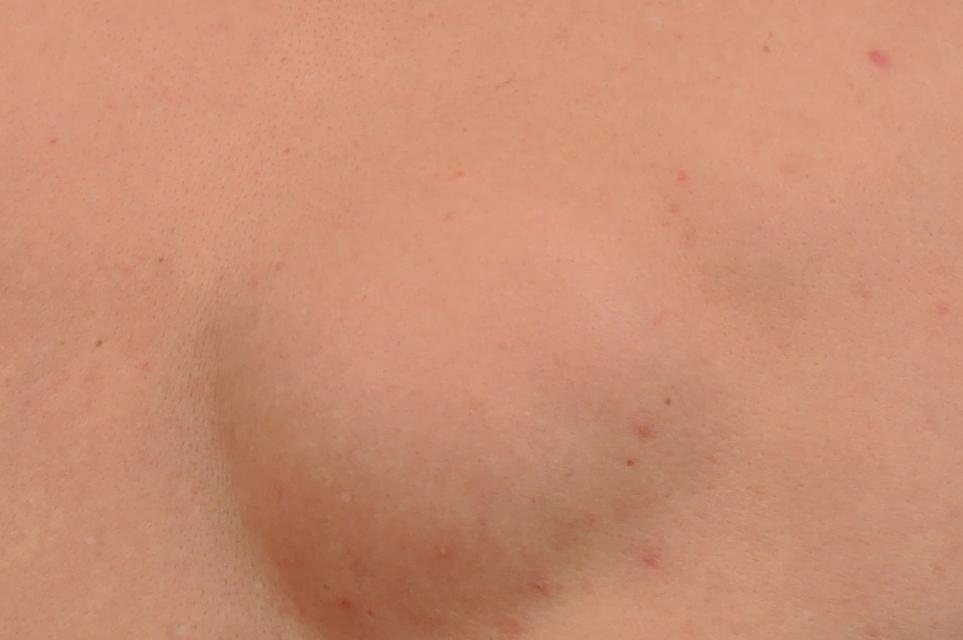 为什么身上会长“肉疙瘩”？是脂肪瘤吗？医生教你如何判断