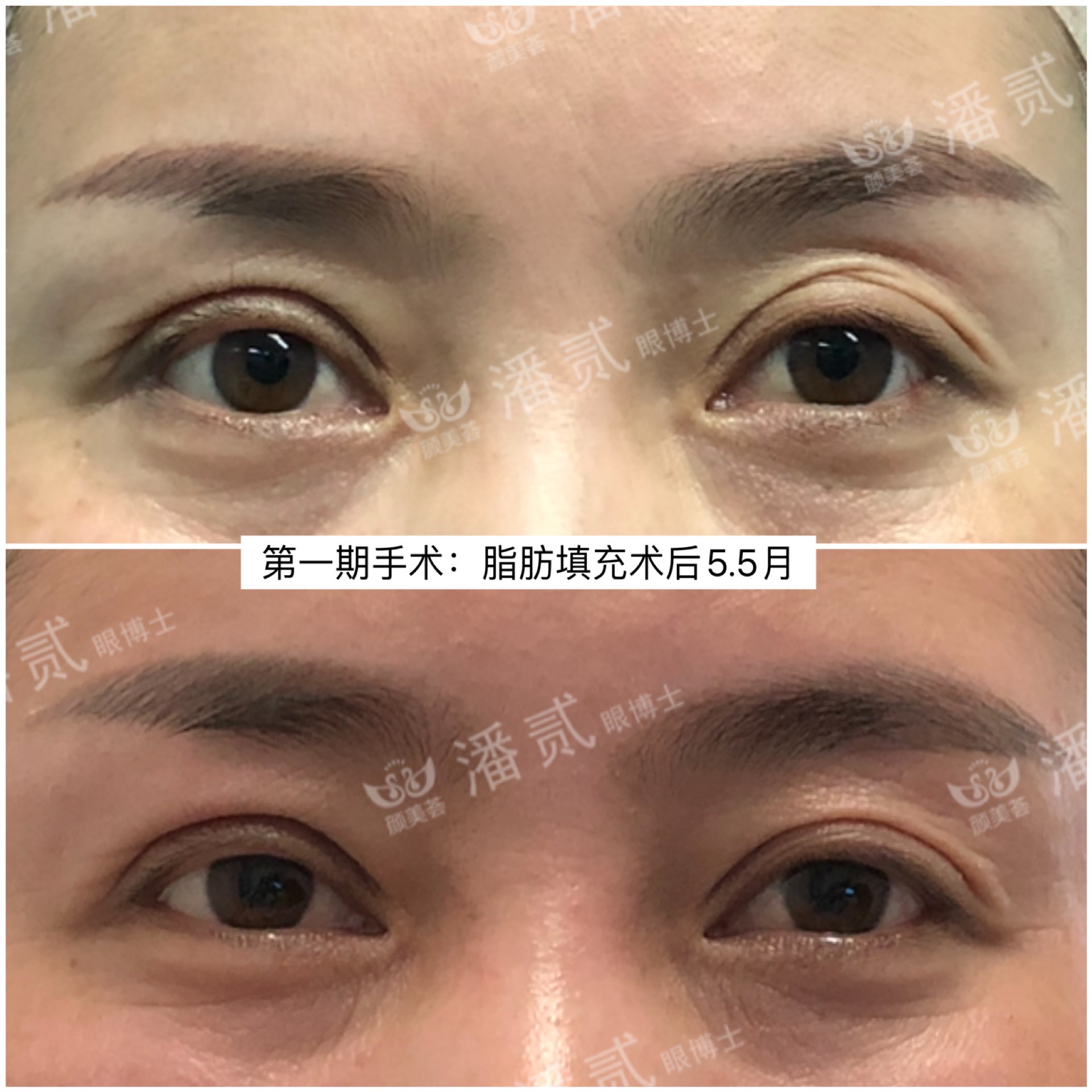 做双眼皮手术后眉毛会变吗,做双眼皮手术的疤痕会消失吗