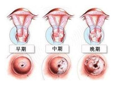 容易患上宫颈癌有哪些人群,年龄较小患上宫颈癌可能性大吗