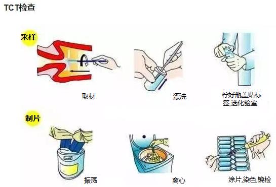 tct检查有异常是宫颈癌吗,tct检查什么样是得了宫颈癌
