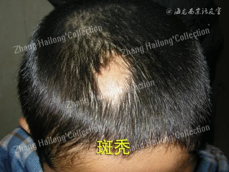 托法替尼治疗斑秃,斑蝥治疗斑秃配方