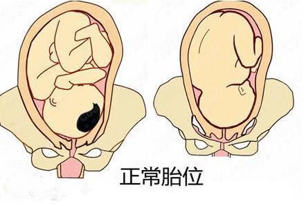 孕检说胎头偏小,胎位不正纠正操做多久才有效果