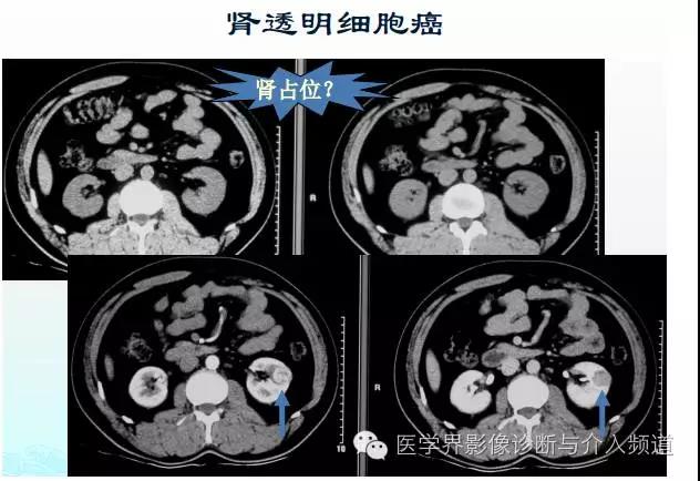 增强ct碘过敏该用什么造影剂,加强ct造影剂过敏皮疹多久能恢复