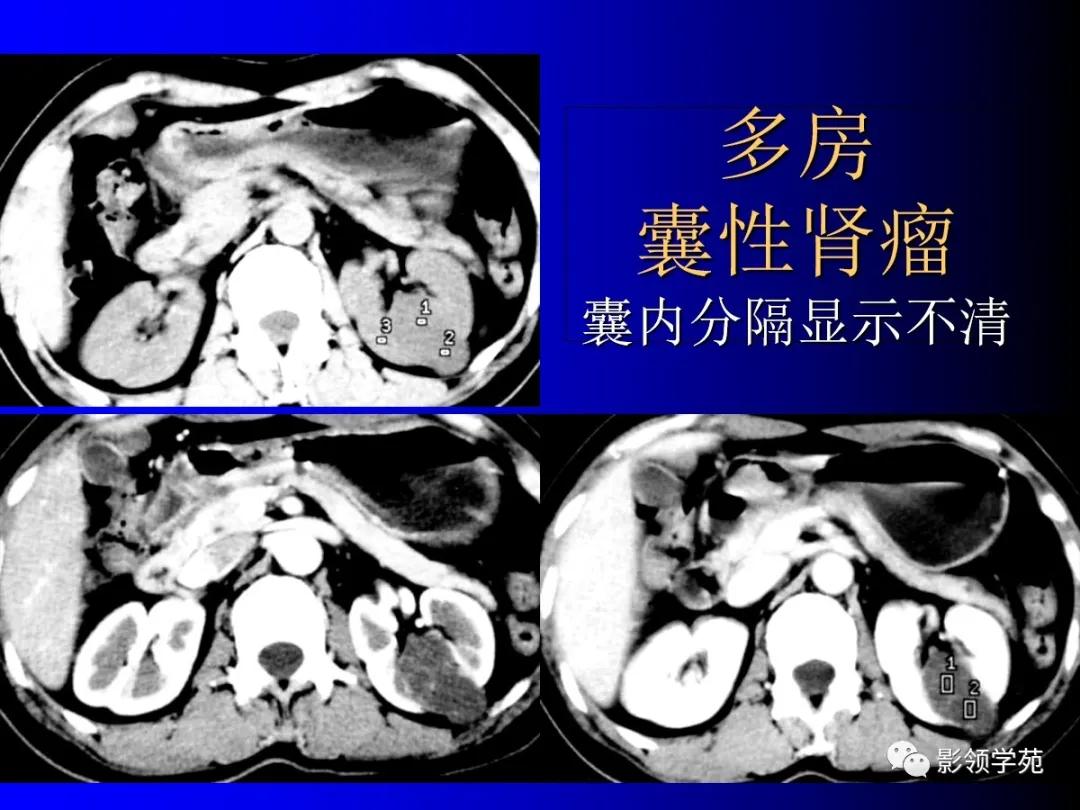 肾脏囊性肿块的影像学特点,肾脏典型病理图片及解析