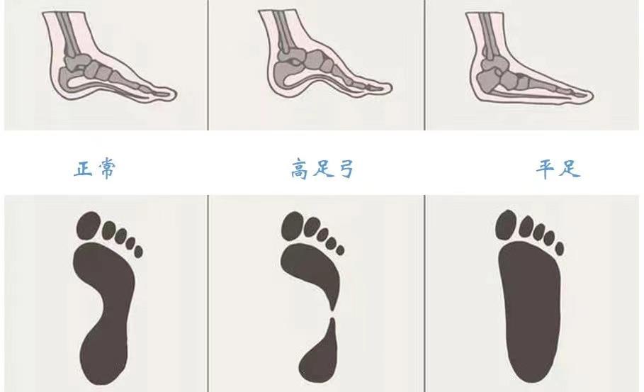 足踝生物力学诊治（足踝生物力学6S中心）