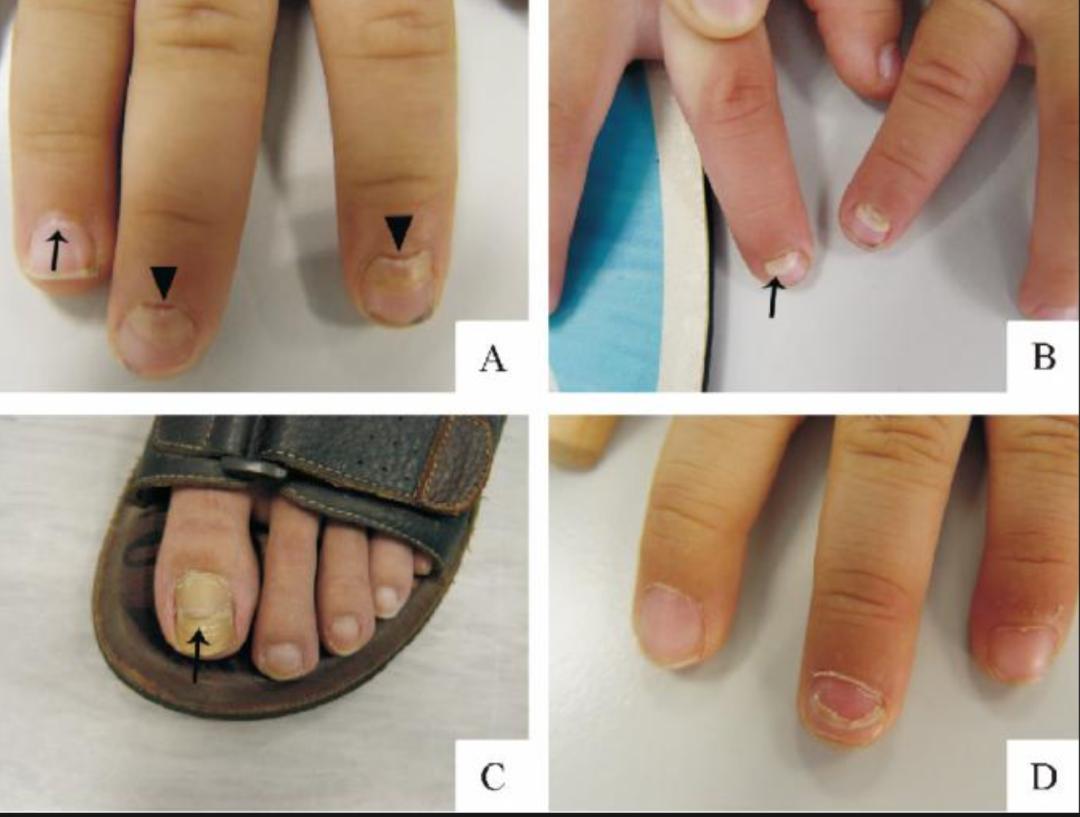 儿童指甲发白脱落是怎么回事,指甲上突然变白一块