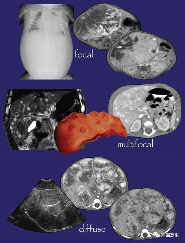 关于肝血管瘤的论文,肝胆外科专家谈肝血管瘤