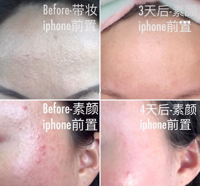 欧阳娜娜快速祛痘,欧阳娜娜力荐茶树祛痘