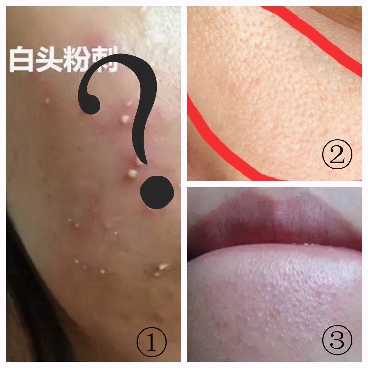 被黑头粉刺挤出来的痘痘怎么办,被粉刺闭口困扰怎么办