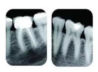 牙医警示看牙第一步为什么要拍片,牙医看牙片可以看出什么