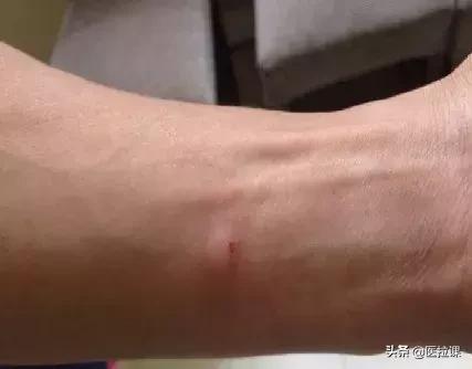 护理学注射法名词解释,基础护理学注射法视频